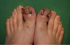 Maybe you would like to learn more about one of these? Using An Ingrown Toenail As Your Excuse For Flip Flops Healthy Feet