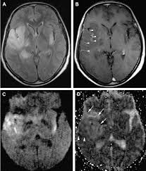 Image result for HSV Encephalitis