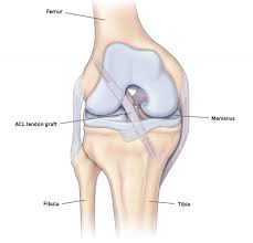 Alongside the posterior cruciate ligament (pcl) lateral collateral ligament (lcl) and Skier S Guide To Acl Tears Arrow Physical Therapy Seattle