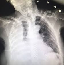 It can also be life threatening. View Of Intra Pleural Tissue Plasminogen Activator And Deoxyribonuclease An Alternative Treatment Option For Pleural Infections In Specific Populations The Southwest Respiratory And Critical Care Chronicles