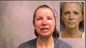 Dr. Lin's J-Plasma SmoothLyft Procedure