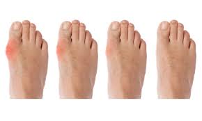 Ia memang pengalaman sebenar pengguna shaklee. Sajaheboh Com Petua Cara Hilangkan Gout Dan Buang Asid Urik Dalam Badan Saja Heboh