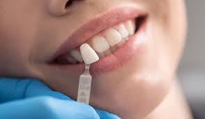 مقایسه هزینه روکش و لمینت 