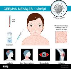 Image result for Rubella