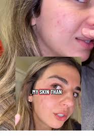 Skin Better Science Clearing Serum Vs Differin