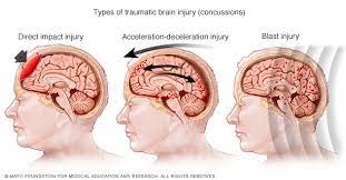 Concussion - Symptoms And Causes - Mayo Clinic