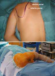 Image result for Scapulothoracic Injection