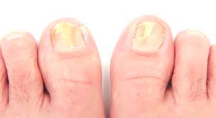 early signs of toenail fungus