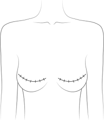 Many women choose to have reconstruction surgery, but it might not be right for everyone. Reconstruction Mammaire Guide Sur Les Interventions Chirurgicales Rccs