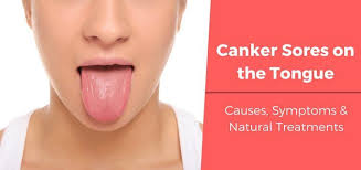 Having Canker Sores On The Tongue Can Cause A Lot Of Annoyance Here Are Some Effective Home Remedies To Treat Cank In 2020 Canker Sore Tongue Sores Canker Sore Remedy