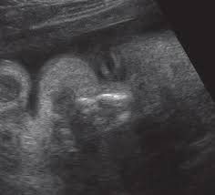 Für mich sieht das küken eher wie ein mädchen aus. 10 Anzeichen Die Angeblich Babys Geschlecht Verraten