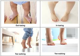 Image result for Out-toeing