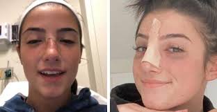 Charli D Amelio Nose Surgery Know The Facts