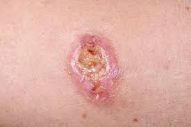 West nile virus west nile virus (wnv) is most commonly transmitted to humans by mosquitoes. Durch Mucken Ubertragbare Erkrankungen Springerlink