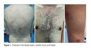 Image result for Pathergy