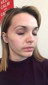 How to get rid of eczema on your face. Saving My Skin A Dermatologist S Take On Eczema Causes Treatment And Skincare Routines Hello
