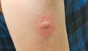 Image result for flea bite