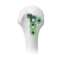Distal Humeral Sub-condylar Locking Plate,Medical Device ...