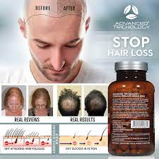 Dht hair loss is often attributed to genetics, so if you notice family members with a receding hairline, you may also be affected. Finasteride Vs Dht Blocker Supplement For Hair Loss