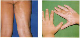 Achromic nevus/Segmental vitiligo. | European Journal of Pediatric  Dermatology