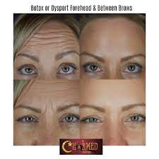 Medicine eyelid, lip, or brow drooping. Botox Dysport Charmed Medispa