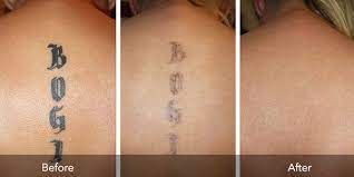 If it is only a 1 tattoo then it is $100 per treatment. Flawless Body Skin Body Laser Aesthetics