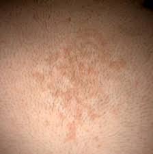 Dermatologo Net Pagina 61 Sus Problemas De La Piel Bien Explicados