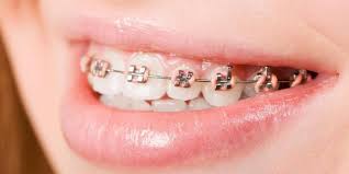 Image result for kawat gigi