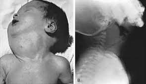 Image result for Goiter