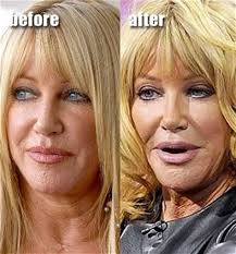 Fial5643 See 17 Facts Of Plastic Surgery Before And After Face In India People Forgot To Tell You