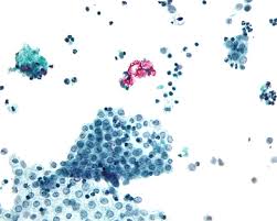 Diagnosis using pleural effusion cytology. Mesothelium Wikipedia