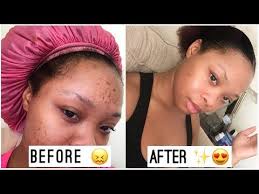 I Got Rid Of My Dark Spots In Less Than A Week Youtube Hyperpigmentation Black Skin Black Skin Care Dark Spots On Skin