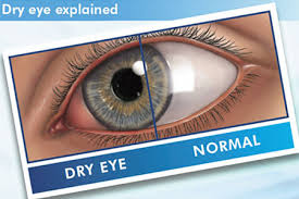 Image result for Dry Eye