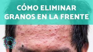 Granos En La Frente Causas Y Como Eliminarlos Youtube