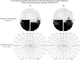Image result for Visual Field Deficit
