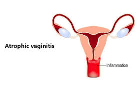 Image result for Atrophic Vaginitis