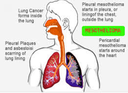 Asbestos is the name of a group of minerals with long, thin fibers. Mesothelioma Lung Cancer