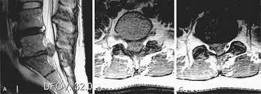 Maybe you would like to learn more about one of these? Cauda Equina Syndrome Clinical Gate