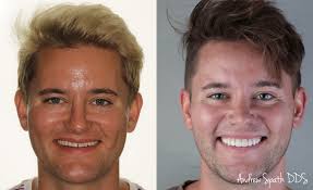 Oral Surgery, Veneers, & Braces in Newport Beach