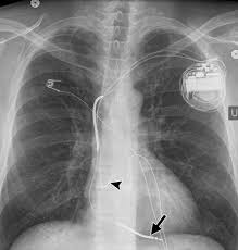 Pacemaker vs implantabilni kardioverterski defibrilator. Radiography Of Cardiac Conduction Devices A Comprehensive Review Radiographics