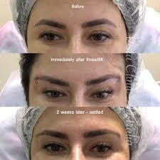 Fox eyes pdo threading and botox to lift the eyebrows ⠀.⠀.⠀ what do you think of this. Pdo Thread Lift Vista Clinic Melbourne Australia