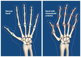 Let's Dig Into Everything about RA - RheumatoidArthritis.org