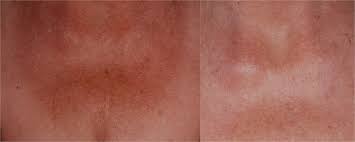 Poikiloderma Red Neck Treatment By Tucson Dermatologists