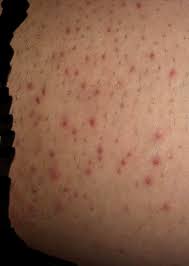 It may be a part of systemic manifestation of a disease or maybe an isolated entity. Hair Removal 9 10 When I Shave My Legs My Inner Thighs Turn Out Like This Any Advice On Preventing This Or If Im Shaving Wrong Skincareaddiction