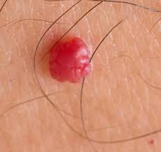 They are made up of small blood vessels and may look like moles. Cherry Angioma Removal Treatment Sydney Contour Clinics