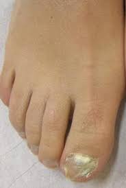 Image result for onychomycosis