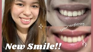 My Crown Lengthening Procedure (new smile yarn)