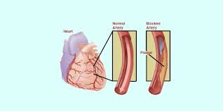 Image result for Angina Pectoris