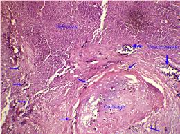 Mucormycosis refers to several different diseases caused by infection with fungi in the order of mucorales. E Histology Of Cavitary Lesion Of Lung Shows Fungal Hyphae Invading Download Scientific Diagram