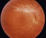 Macular Pucker Louisville Eye Health Eye Surgery Eye Care Center
